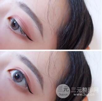 埋线双眼皮的优点