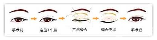 什么是定点双眼皮?