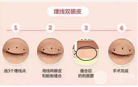 定点双眼皮是埋线吗?
