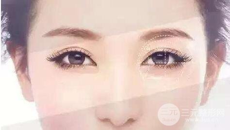 定点双眼皮和埋线双眼皮的区别有什么?