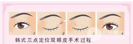 定点双眼皮和埋线的区别