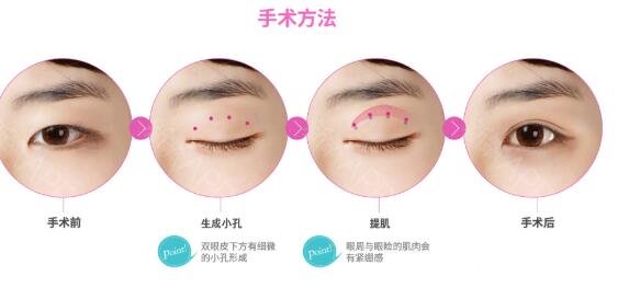 什么是切开双眼皮?