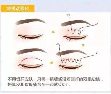 埋线双眼皮手术法