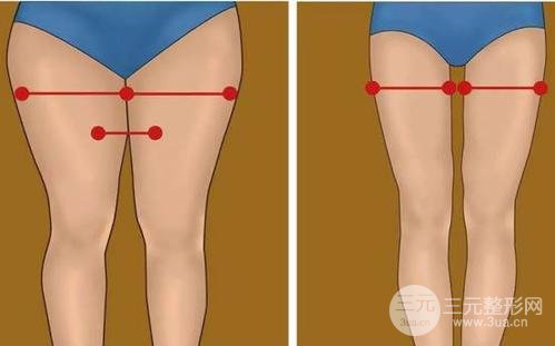吸脂瘦大腿肿胀期是多久？多久能看到果？