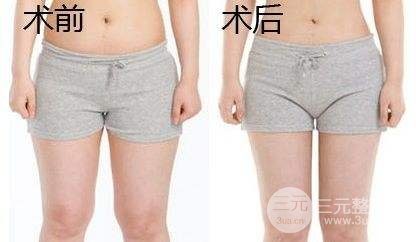 吸脂瘦大腿肿胀期是多久？多久能看到果？
