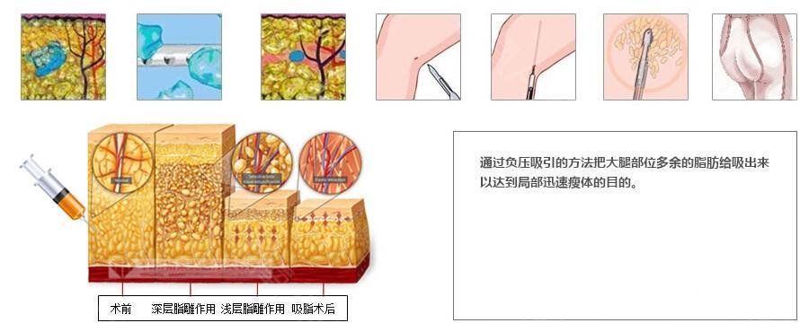 吸脂瘦大腿肿胀期是多久？多久能看到果？