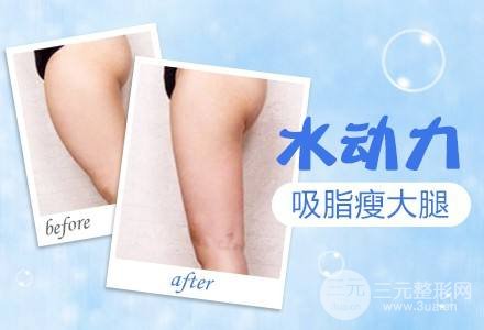 吸脂瘦大腿肿胀期是多久？多久能看到果？