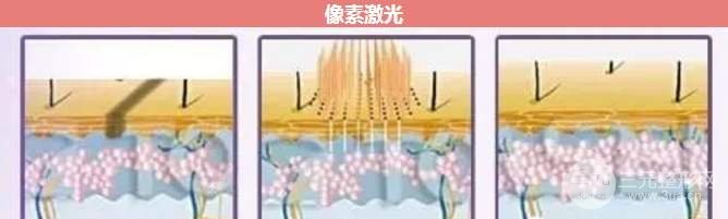 像素激光祛痘成好吗？看完你就知道了！