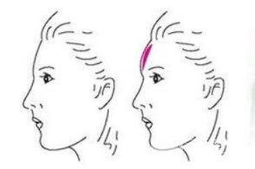 丰额头有几种方法 假体填充额头果怎么样
