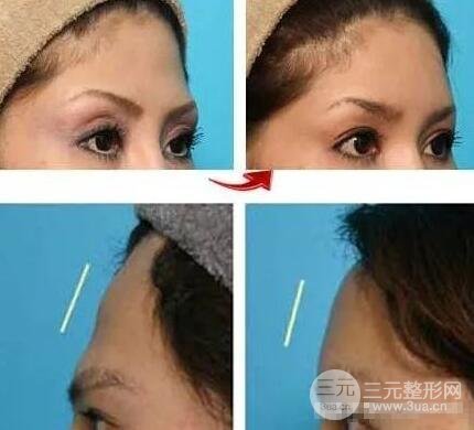 丰额头有几种方法 注射填充额头多少钱