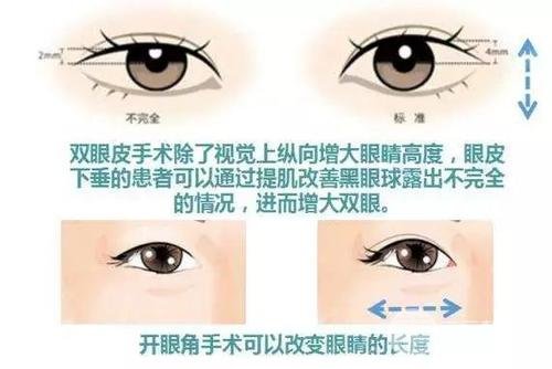 微创开眼角真的“微创”吗
