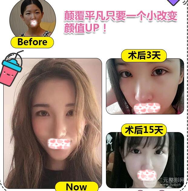 微创开眼角案例图 果好不好 多少钱
