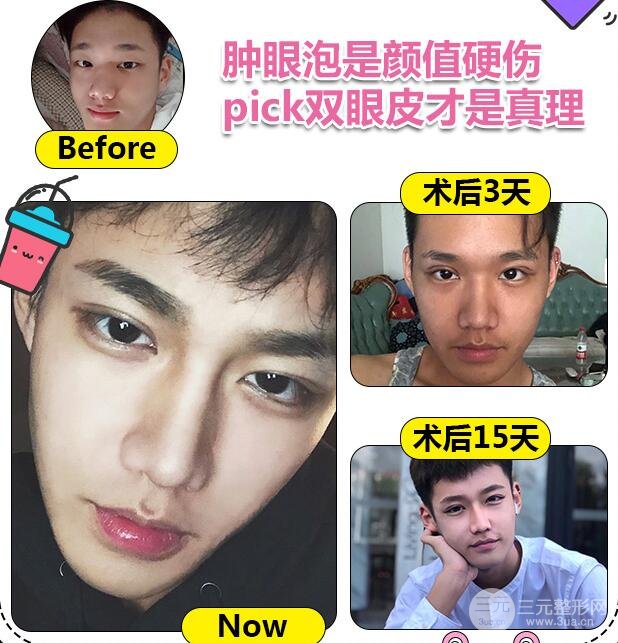 微创开眼角术前术后对比图 价格 案例