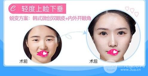 什么是微创双眼皮手术？
