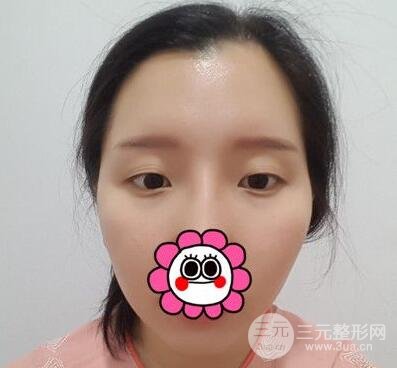 微创双眼皮恢复的过程