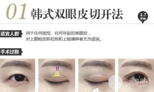 微创双眼皮是长时间的吗?