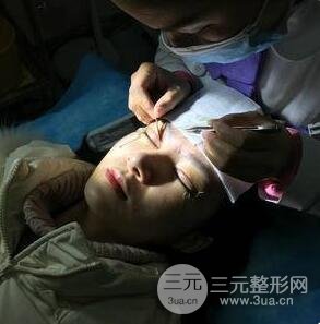 微创双眼皮的价格如何?