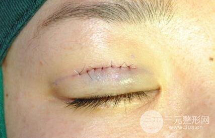 微创双眼皮手术后，该如何护理?