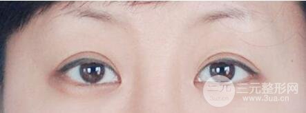 开眼角的风险