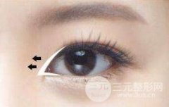 开眼角多久恢复？开眼角手术的恢复时间！