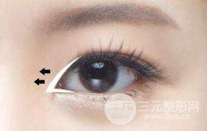 开眼角多久恢复？开眼角手术的恢复时间！