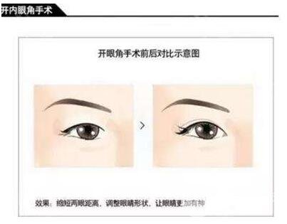 开眼角的价位