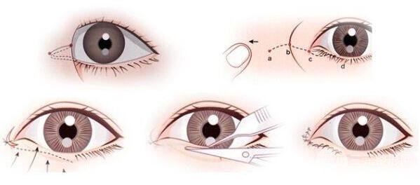 什么是开眼角手术?
