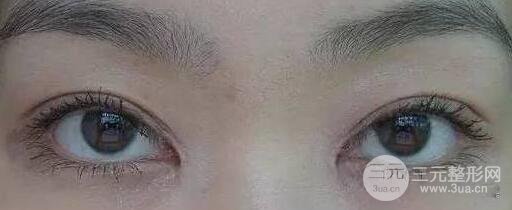 开眼角的术后注意事项