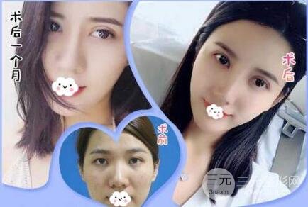 浙江二院整形外科双眼皮案例