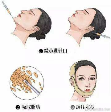 面部吸脂手术原理