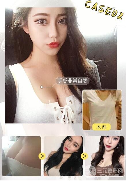 麦格、娜绮丽假体隆胸哪种比较好 案例图