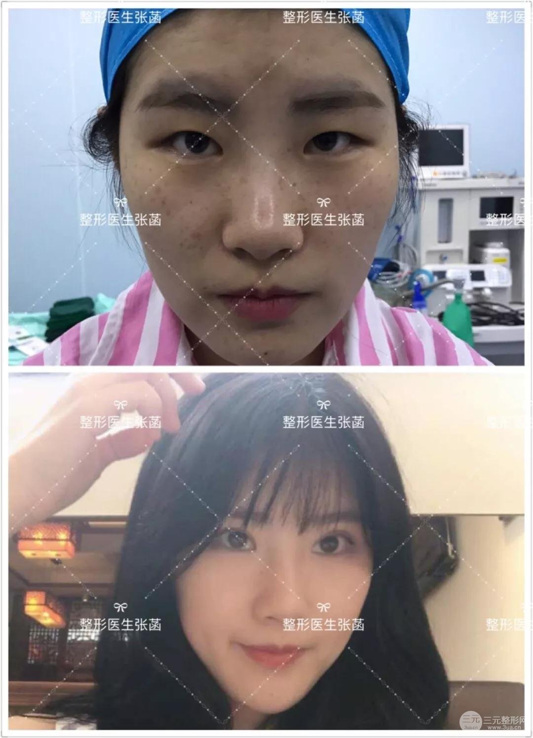 专业双眼皮手术案例图