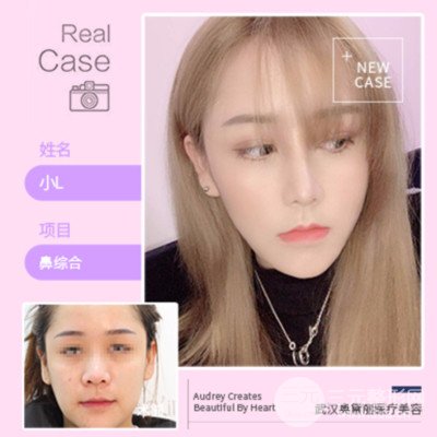 假体隆鼻怎么样 案例果图