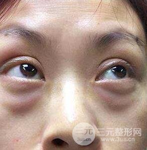 去眼袋手术有什么风险?