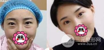 去眼袋后的注意事项