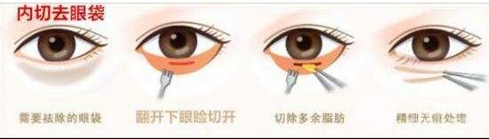 什么是去眼袋手术?
