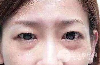 去眼袋手术后要注意些什么?