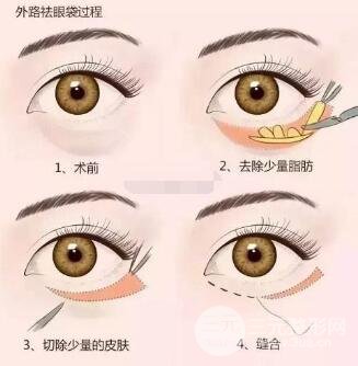 去眼袋的手术方法有哪些?