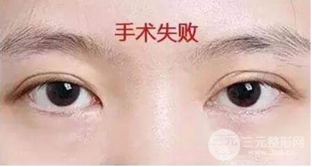 双眼皮修复手术应该几天之后进行还是几个月之后?