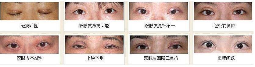 双眼皮修复的时期