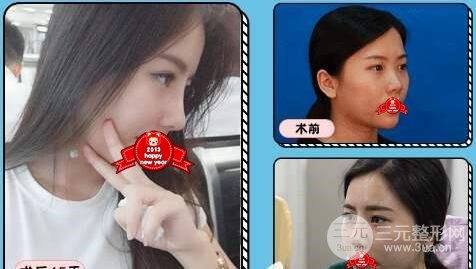 浙二整形科隆鼻整形案例