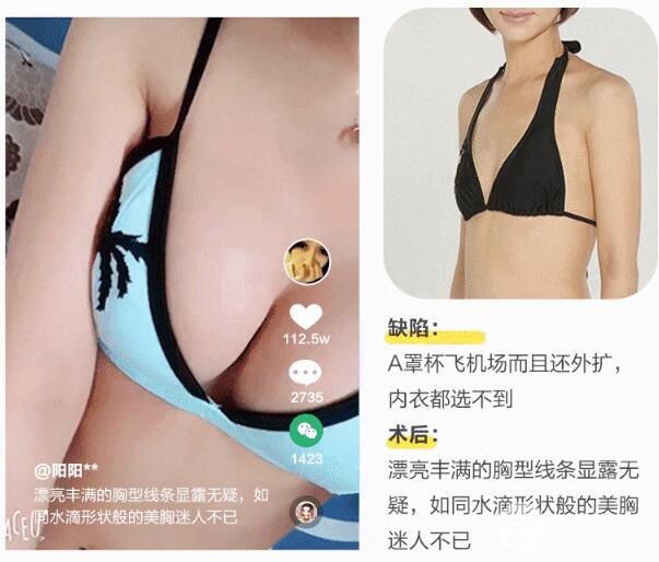 自体隆胸手术失败修复果好不好 案例图