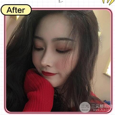 隆鼻失败修复手术案例图 术后果