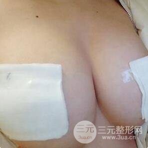 抽脂隆胸手术的注意事项
