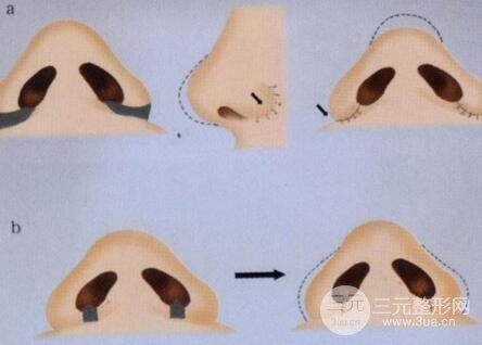 鼻翼缺损修复手术**高