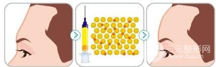 自体脂肪隆额头