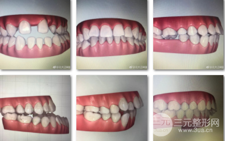 赛德阳光周彦恒正畸多少钱