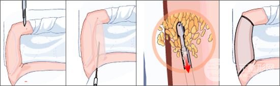 手臂吸脂有必要全麻吗？