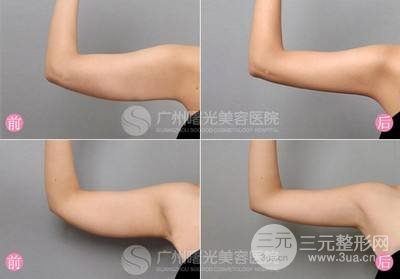 手臂吸脂果图