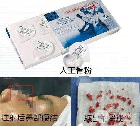骨粉隆鼻的危害